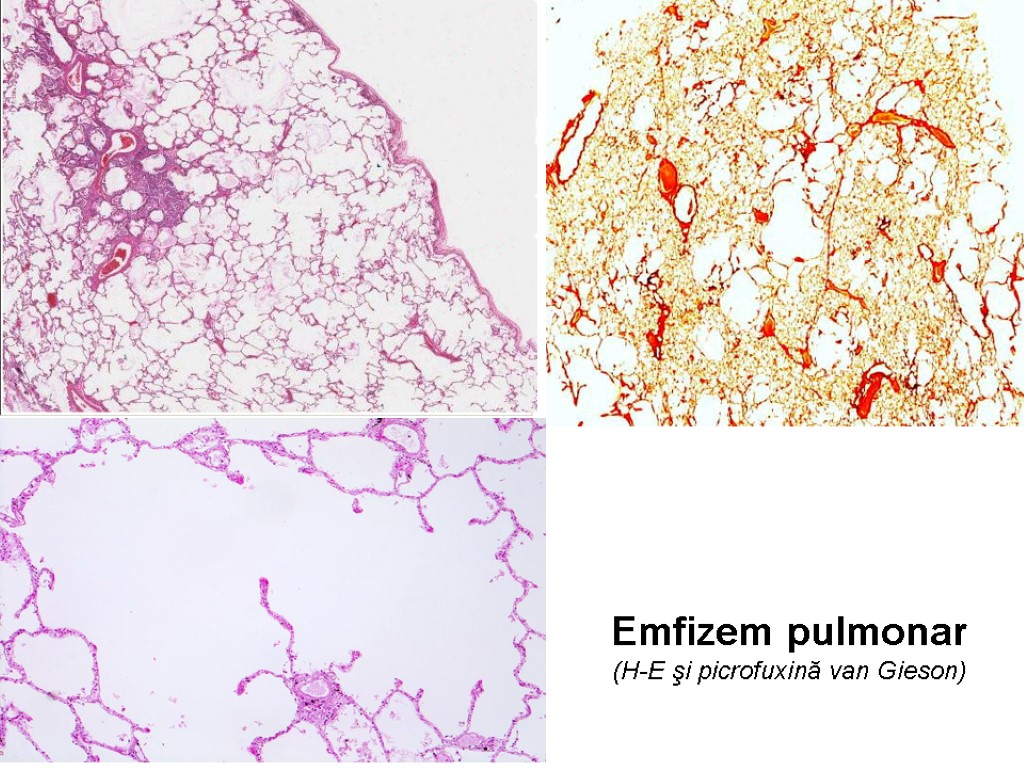 Emfizem pulmonar (H-E şi picrofuxină van Gieson)
